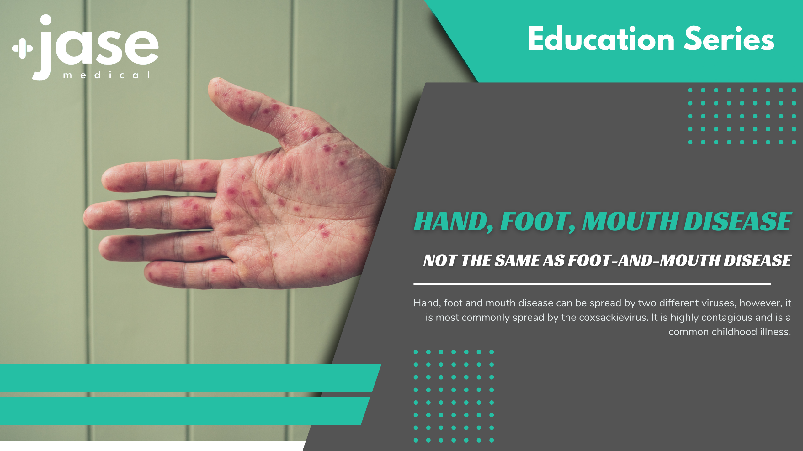Hand, Foot, Mouth Disease