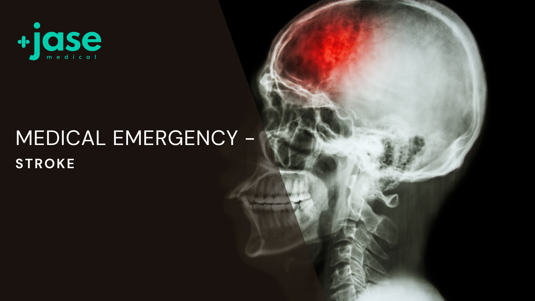 Medical Emergency &#8211; Stroke