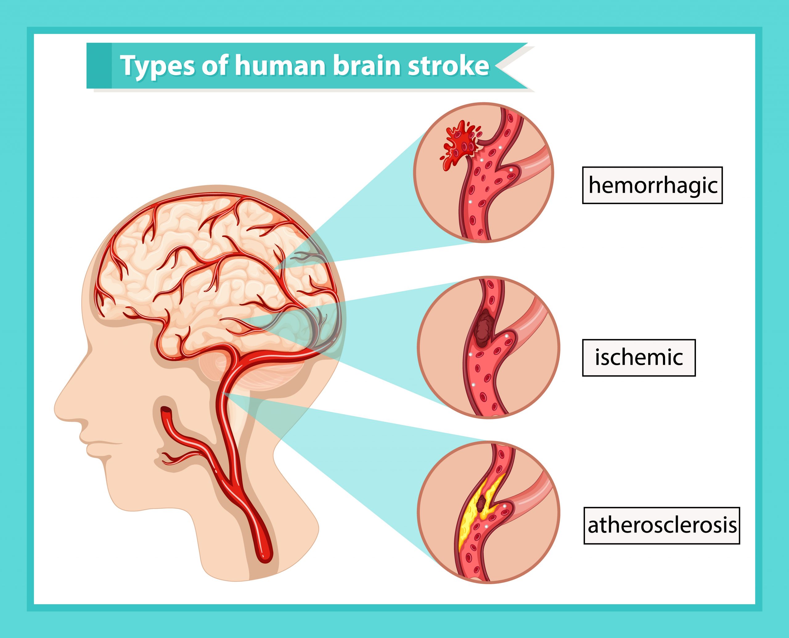 Medical Emergency &#8211; Stroke