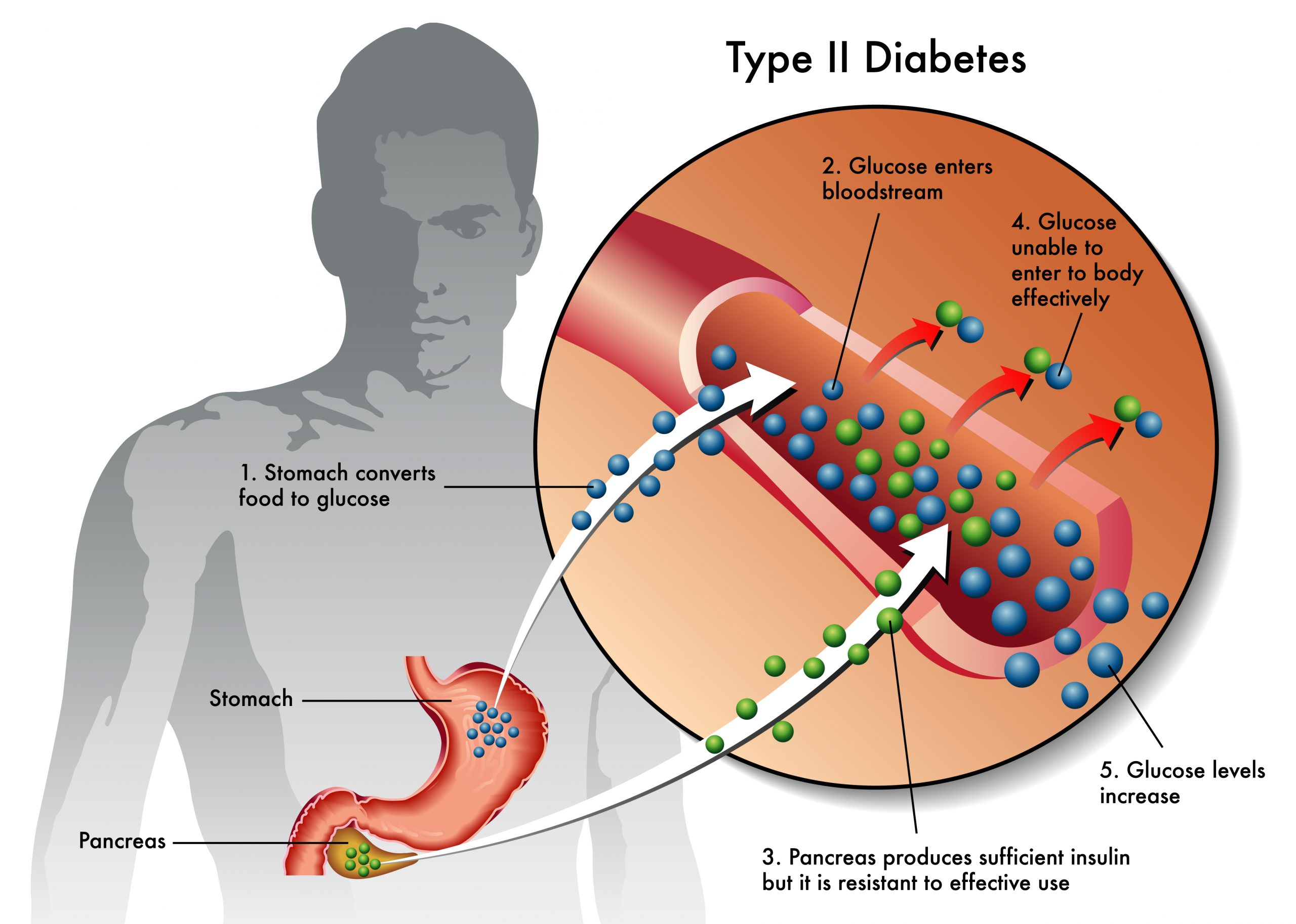 Popular Pesticide That Was Recently Banned Associated With Type 2 Diabetes