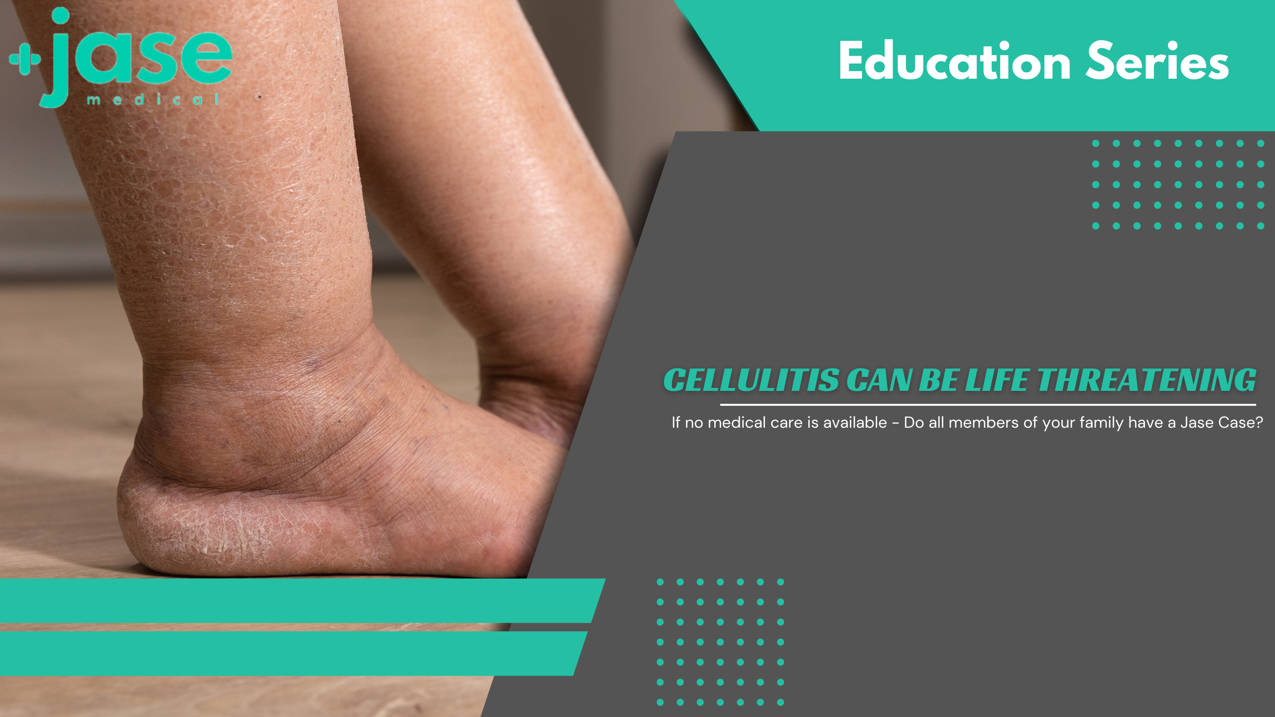 Cellulitis can be Life Threatening