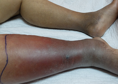 Cellulitis can be Life Threatening
