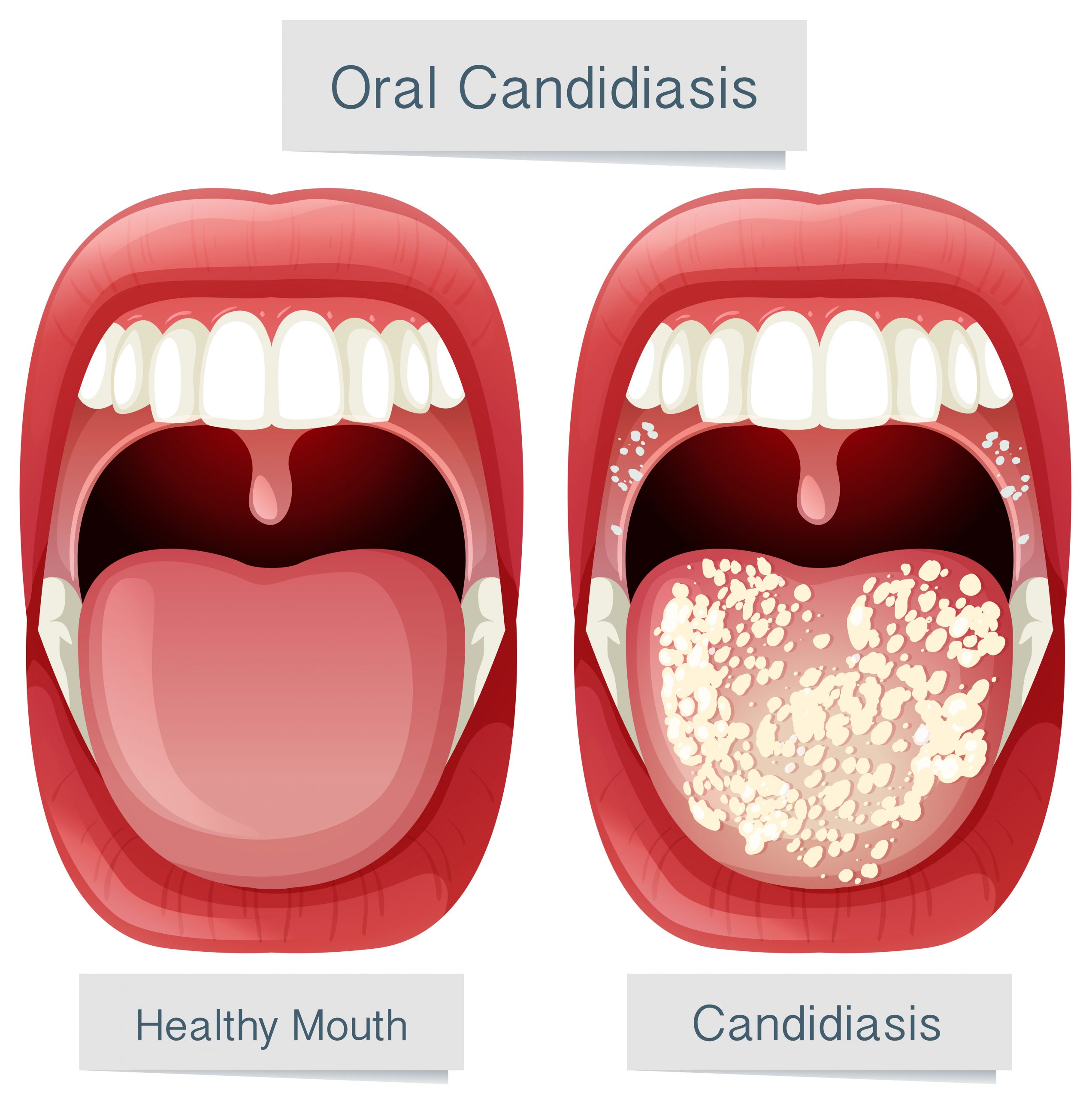 Does Your Sore Throat Need An Antibiotic JASE Medical