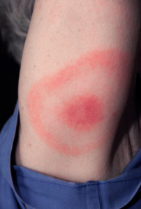 For Clinicians | After the Tick Bite: The Tick Decides the Risk