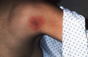 For Clinicians | After the Tick Bite: The Tick Decides the Risk